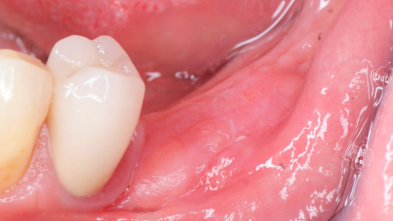 Regeneración ósea y dos implantes — después