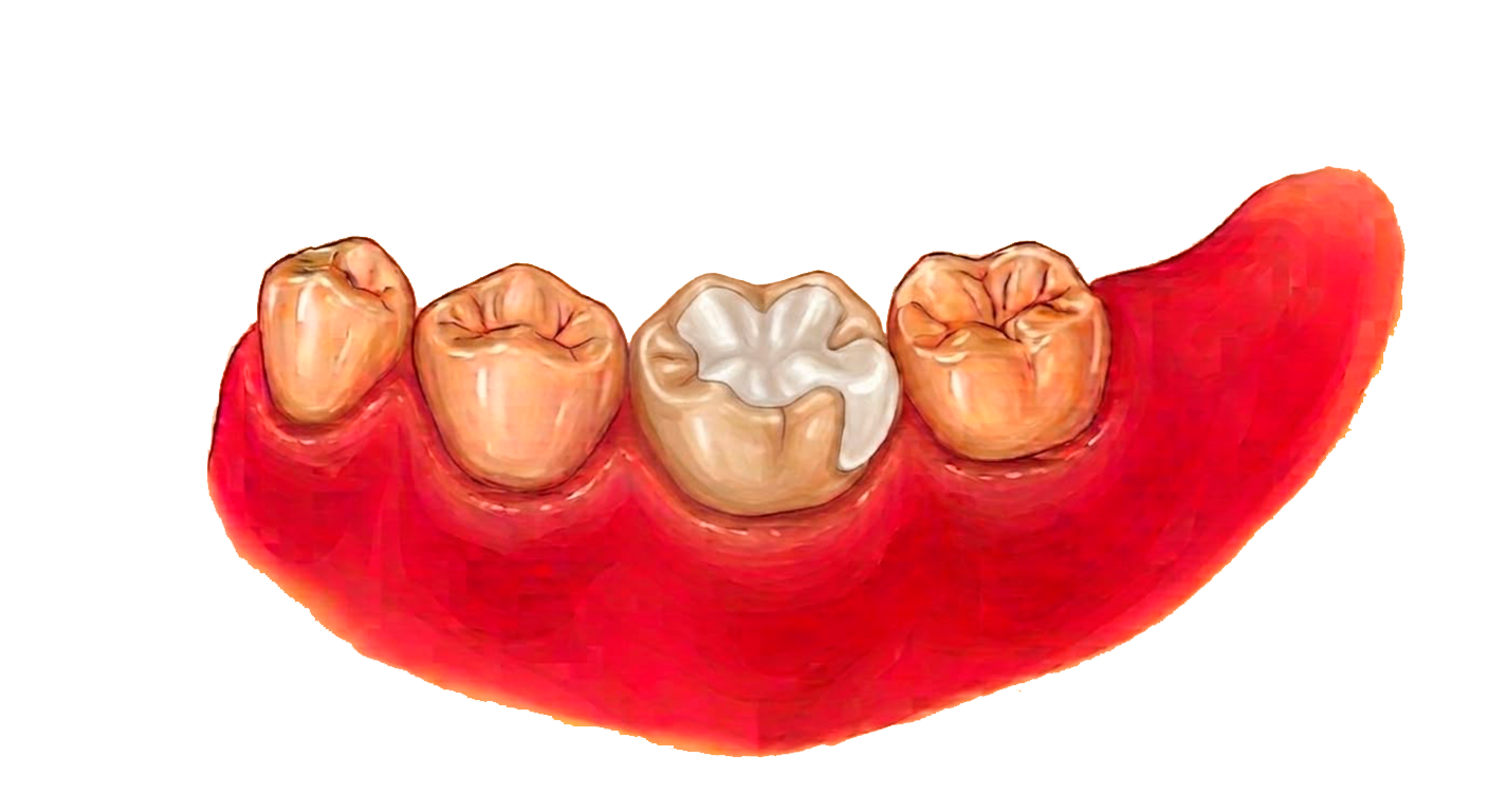 Ilustración de un molar con una reconstrucción amplia en resina blanca