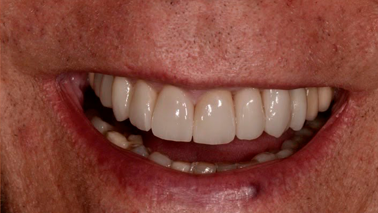 Armonización de sonrisa y encía — después