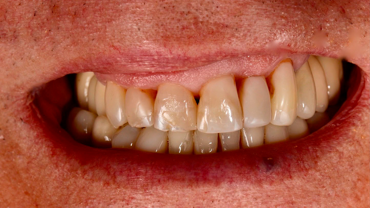 Armonización de sonrisa y encía — antes