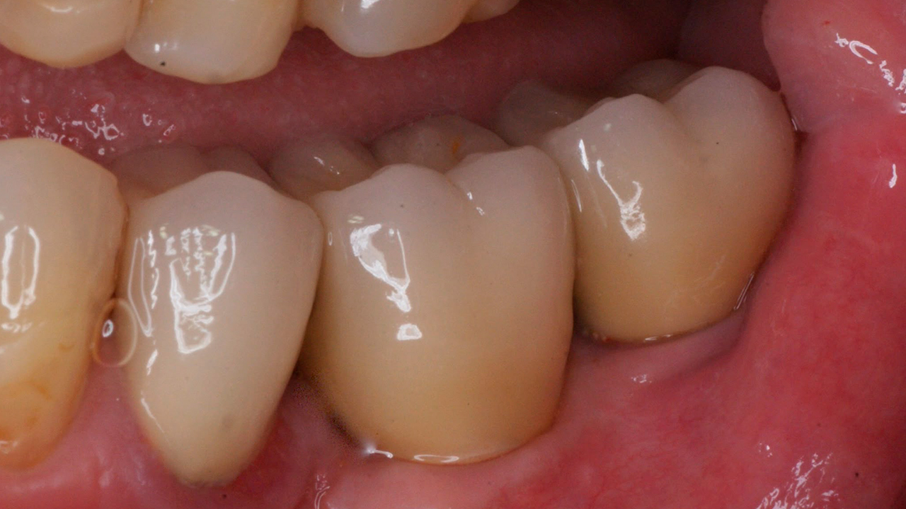 Regeneración ósea y dos implantes — antes