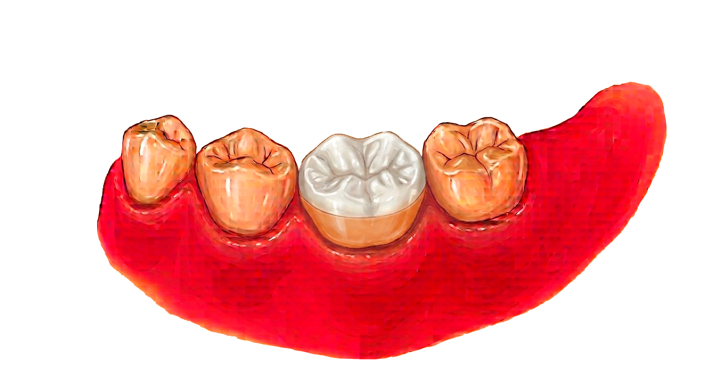 Ilustración de un molar con una incrustación de cerámica adherida sobre la encía