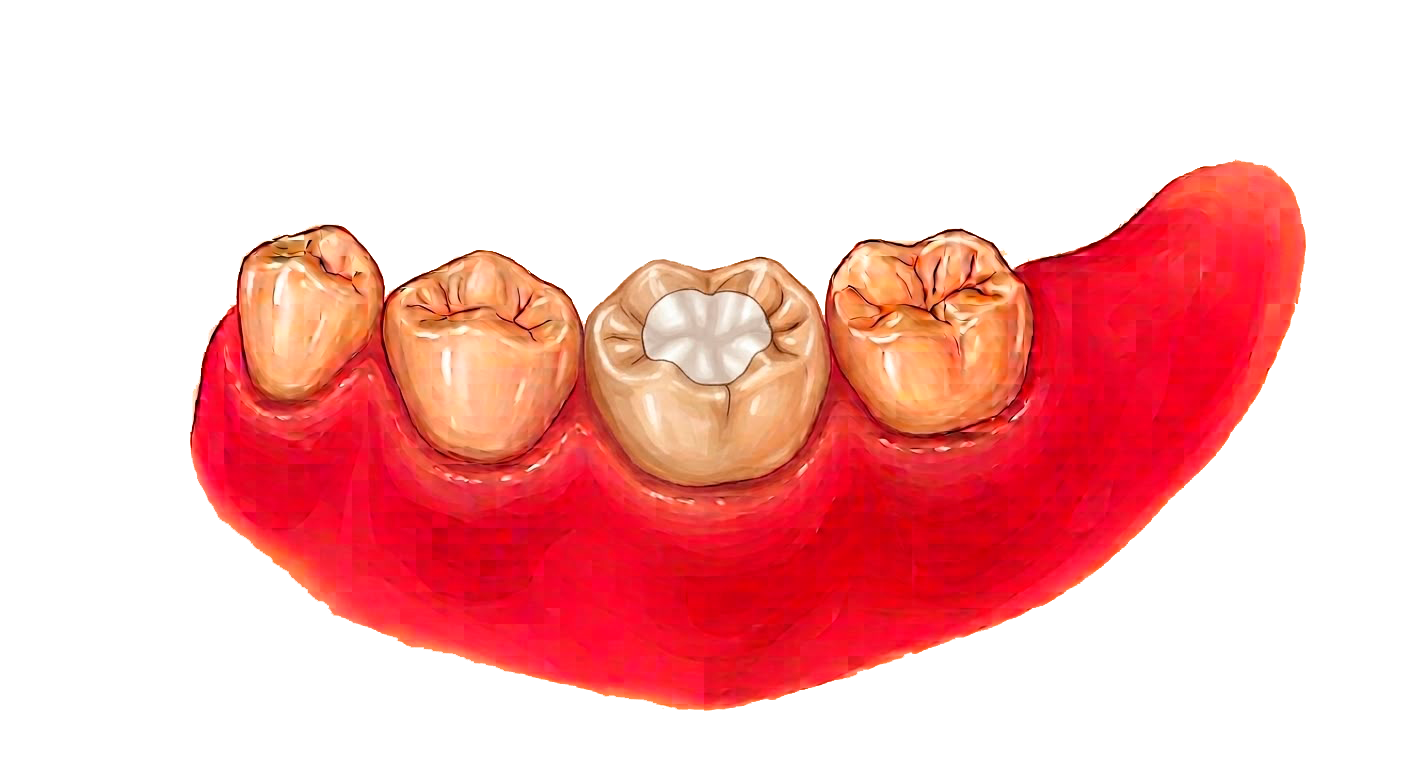 Ilustración de un molar con una obturación blanca sobre la encía
